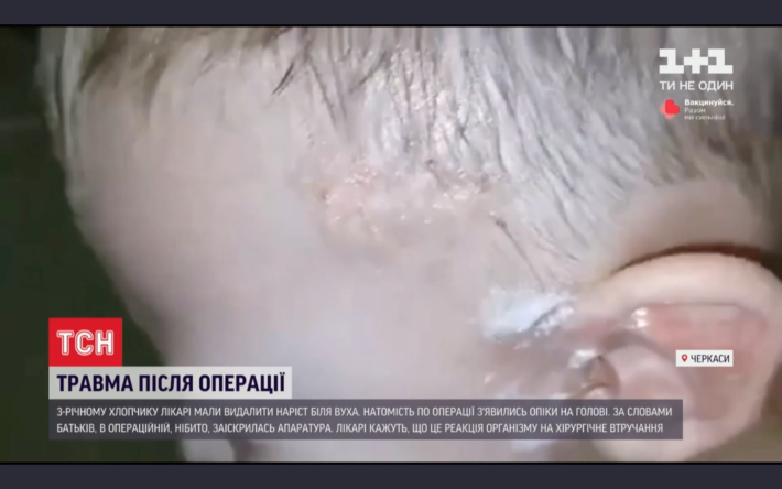 Під час планової операції трирічний хлопчик із Черкас отримав опіки шкіри голови (ВІДЕО) — Новини Черкас за сьогодні